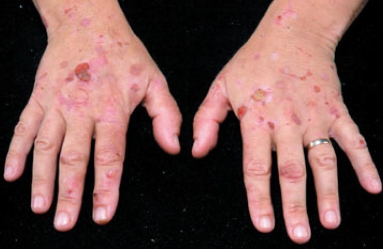 Diagnose The Skin Lesion