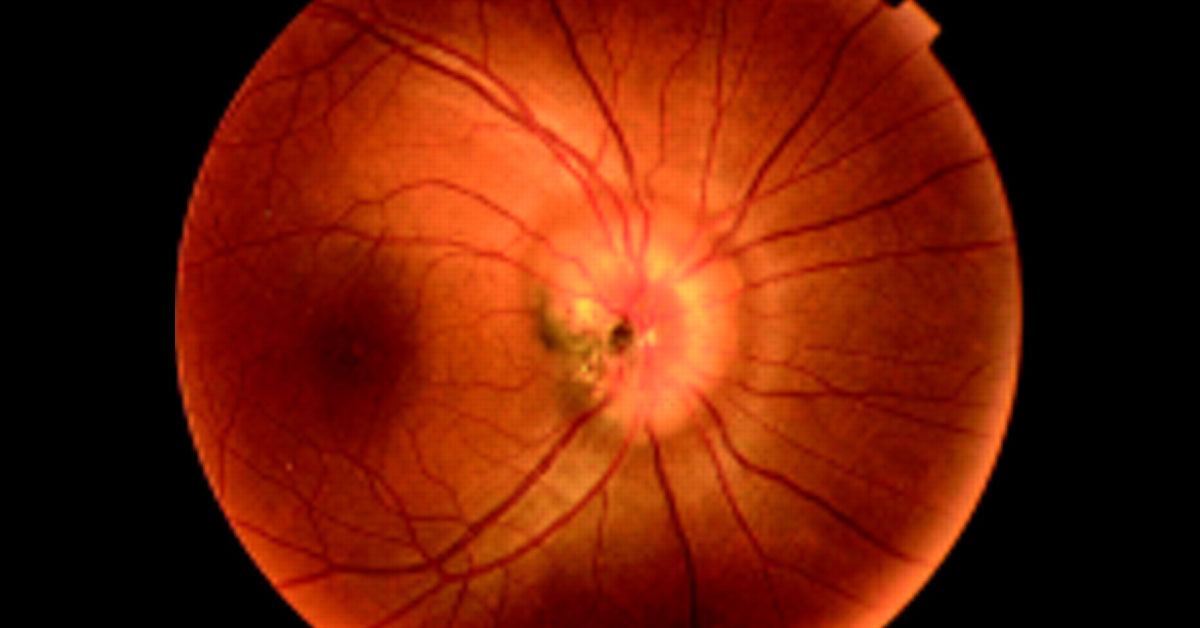 Brief Review Of Morning Glory Disc Syndrome