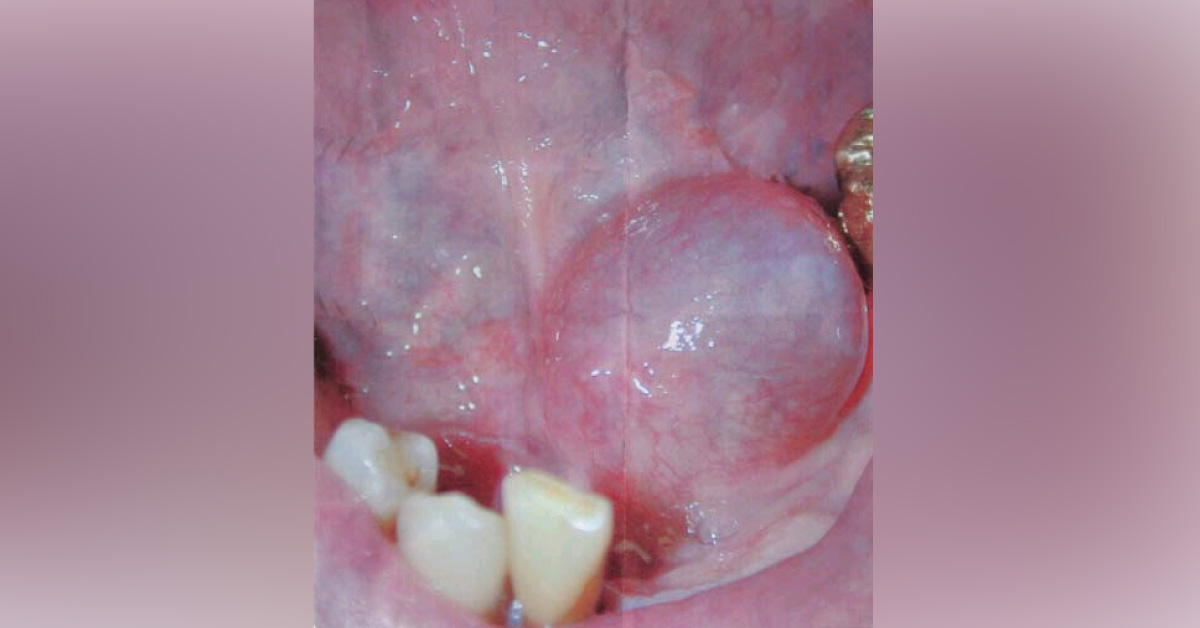 Dome-shaped Swelling on the Floor of the Mouth