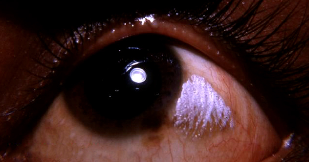 Brief Review On Ocular Manifestations Of Vitamin A