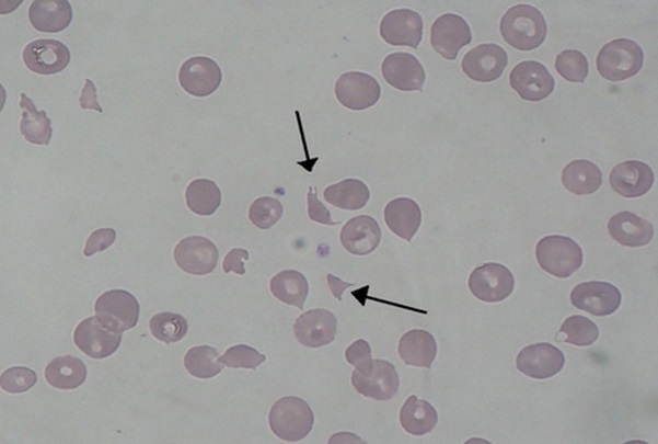 What Abnormality Do You See In This Blood Smear?