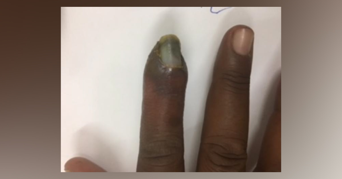 Identify This Discoloration Of Index Finger