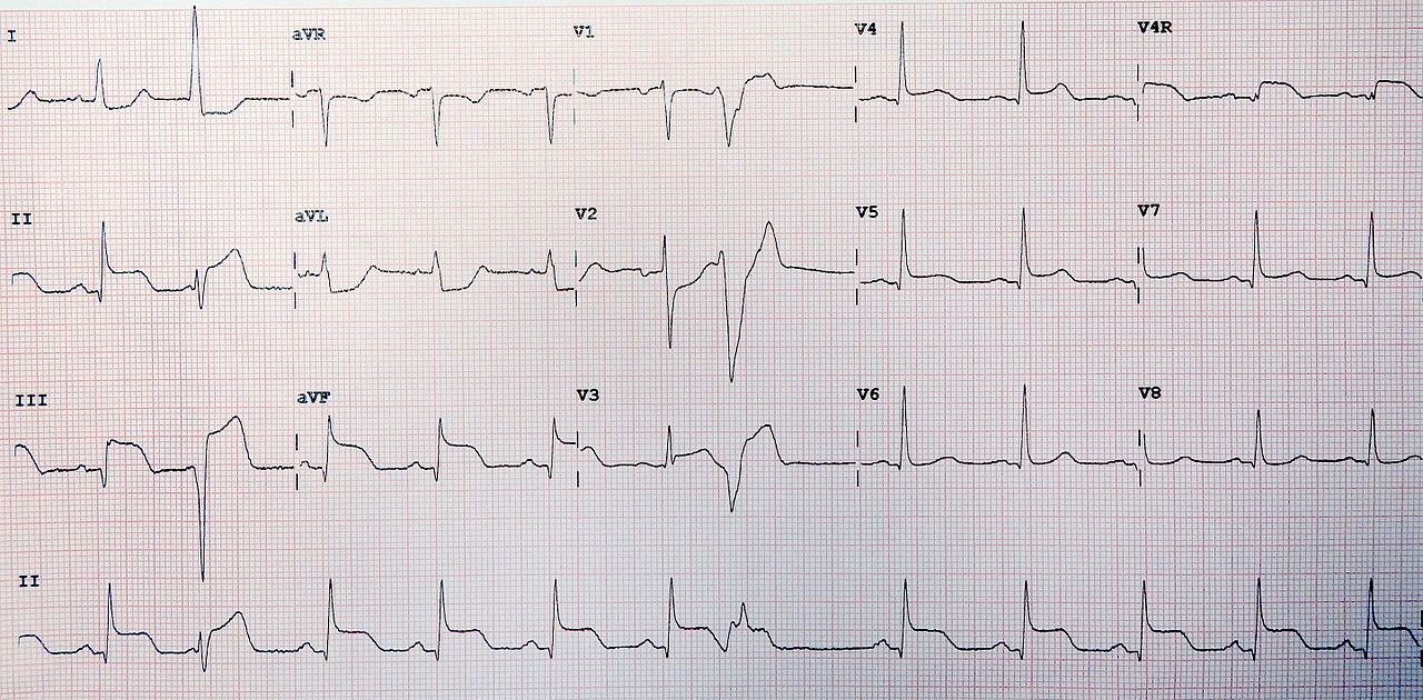 An Interesting Quiz About ST Segment Elevation