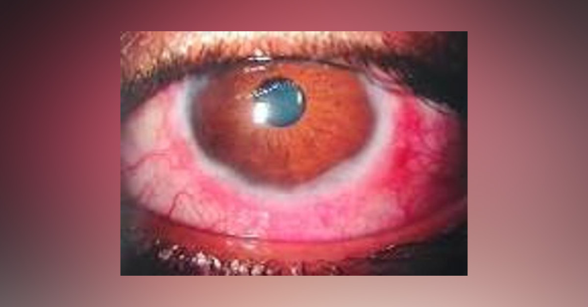 Old Vs New Treatment In The Management Of VK Conjunctivitis