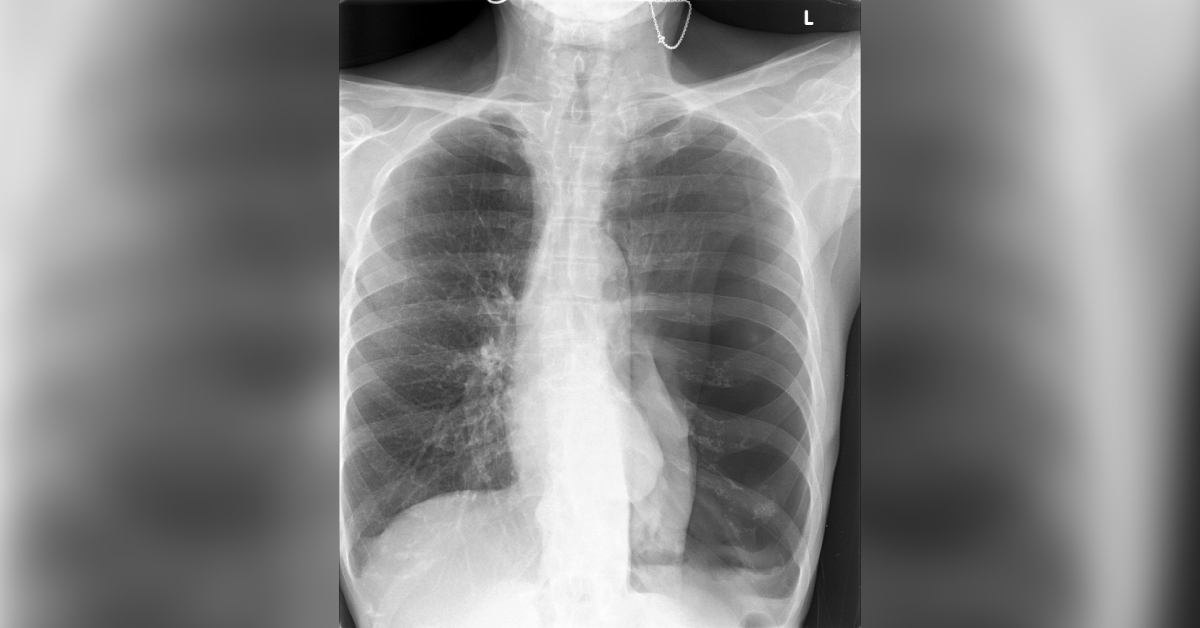 Male With Reduced Oxygen Saturations And Tachycardia