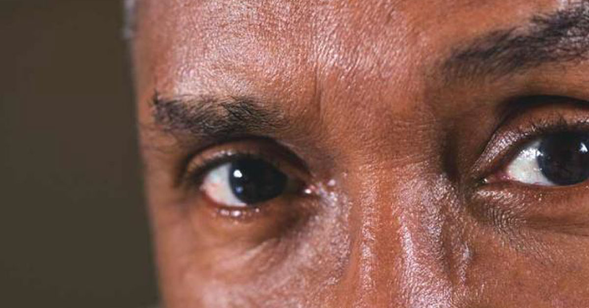 Brief Review On Ocular Manifestations Of Impending Stroke