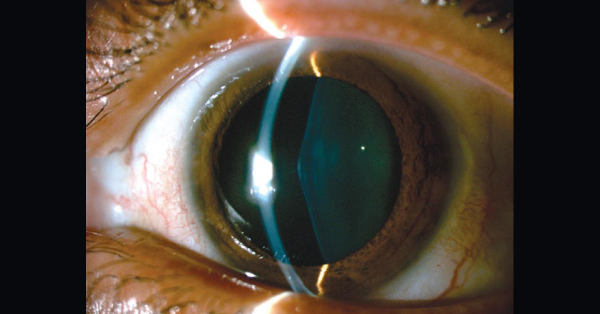 Ocular Manifestations Of Alports Syndrome A Brief Review
