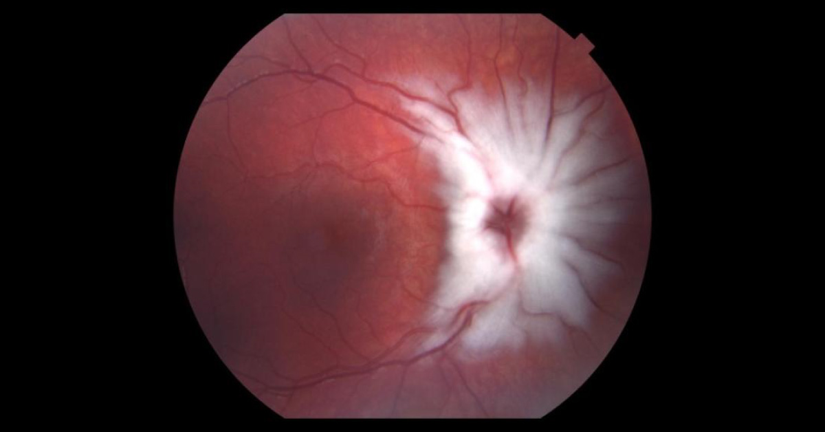 Brief Review On Medullated Optic Nerve Fibers
