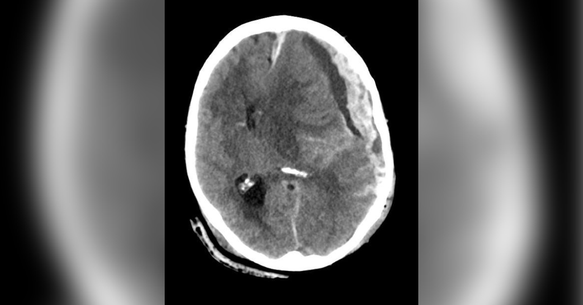 An Unconscious Man with Dilated Pupil