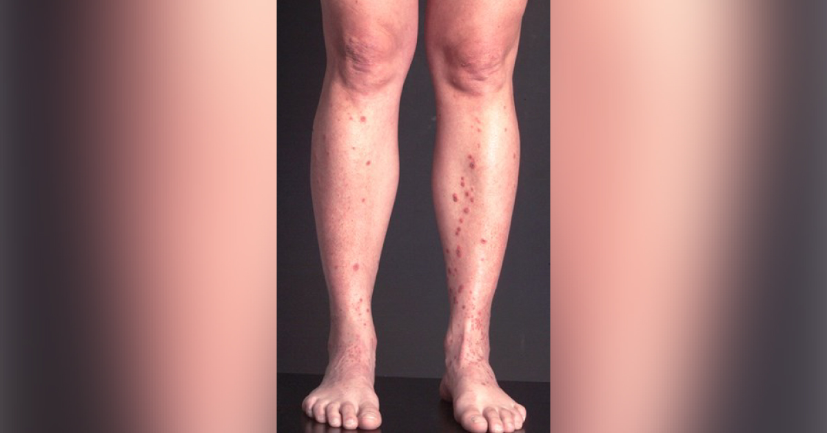 Identify This Dermatological Condition