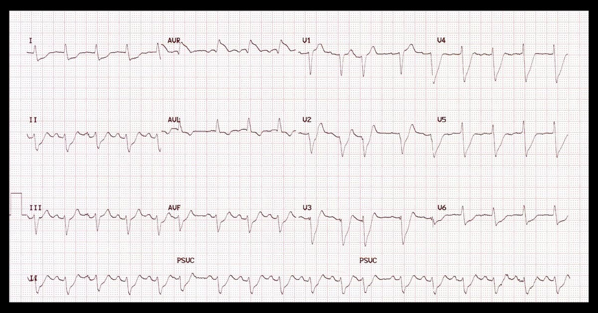 Syncope And Severe Chest Pain