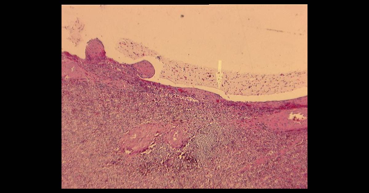 A Man With Liver And Kidney Masses