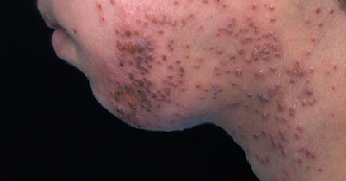 A Boy With Worsening Eczema