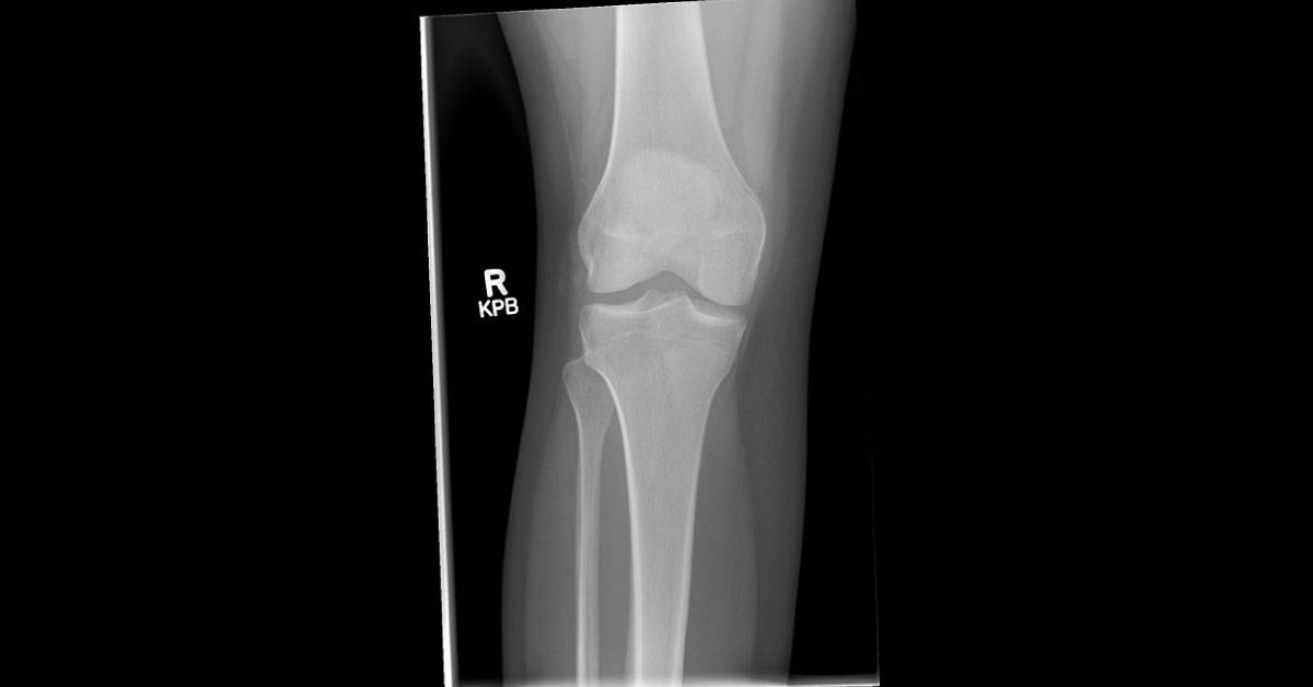 Recommend The Best Treatment For This Knee Injury