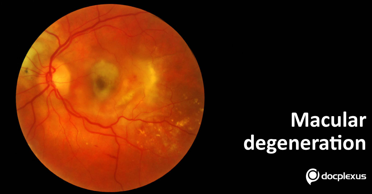 Bevacizumab for Macular Degeneration