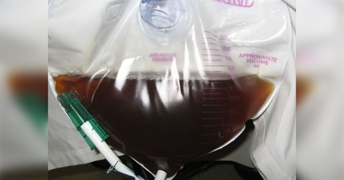 Case Of Abnormal Urine