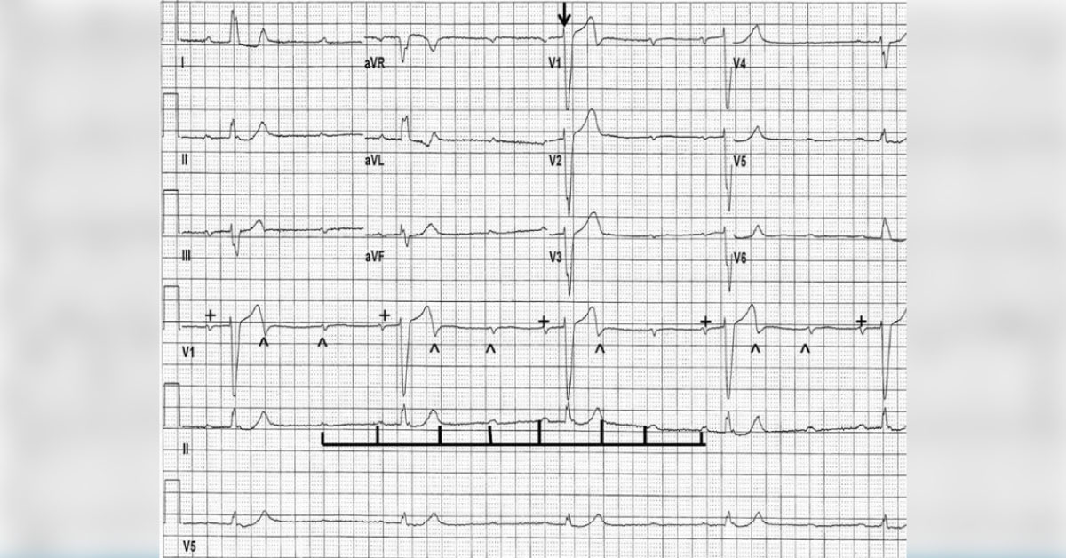 A Woman with Low Pulse
