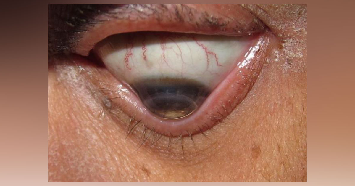 Brief Review On Madarosis
