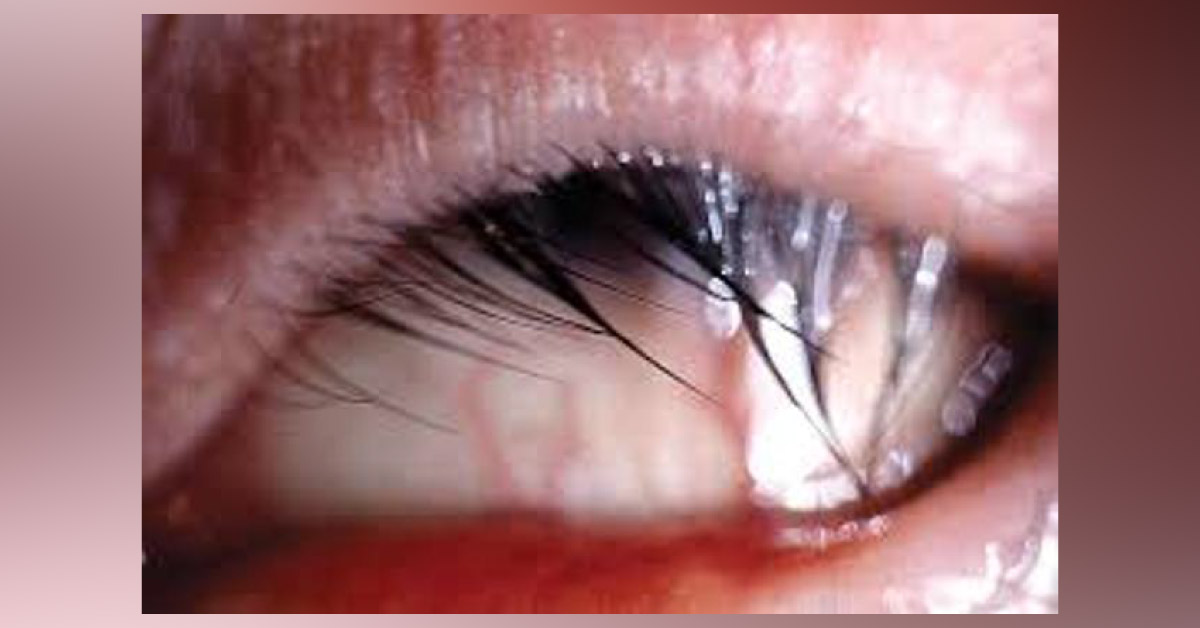 Brief Review On Trichiasis