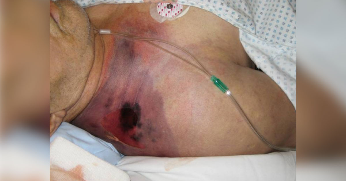 Gas Gangrene, What’s The Cause?