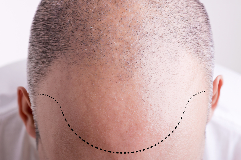 What’s The Best Age To Get An FUE Hair Transplant?