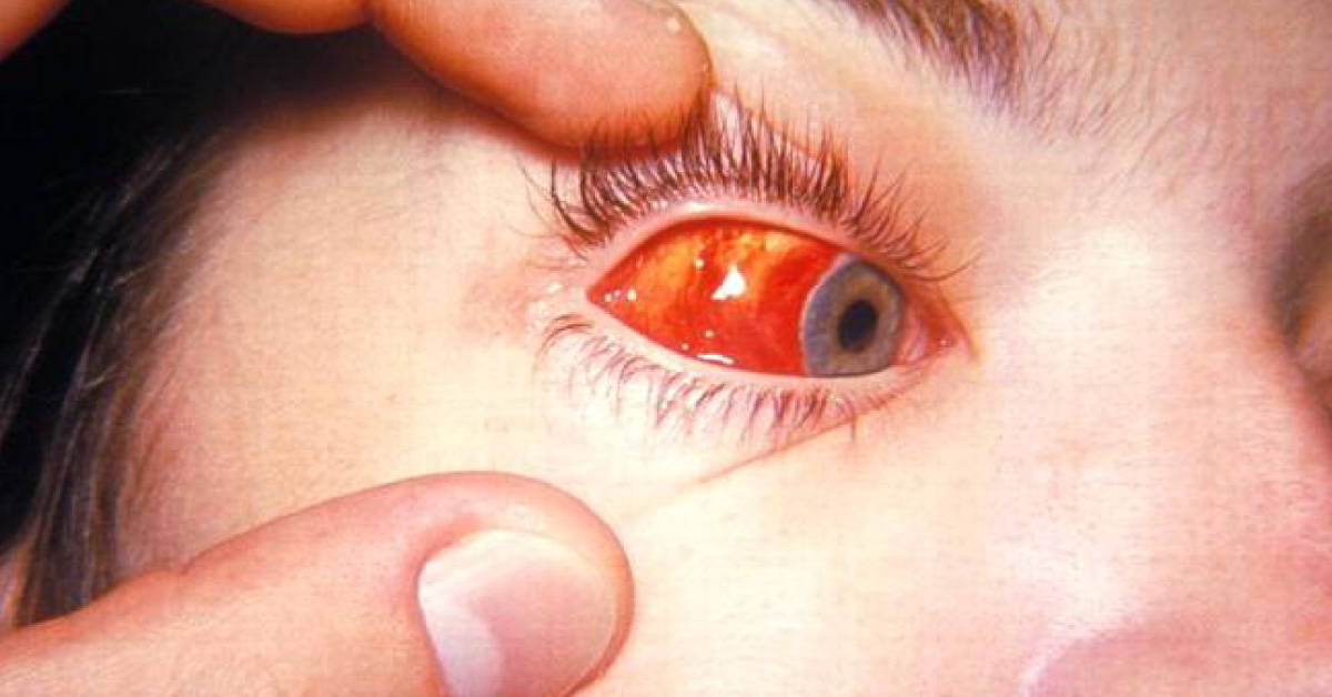 Ocular Manifestations Of Infectious Mononucleosis