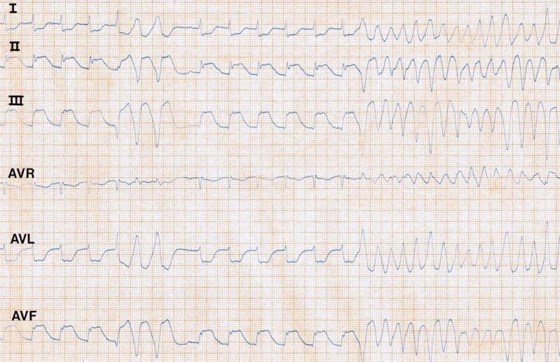 What Abnormality Can You Detect From This ECG?