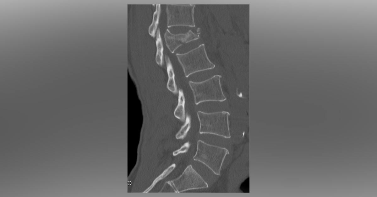 Interpret The Diagnosis From This Sagittal CT Of Lumbar Spine