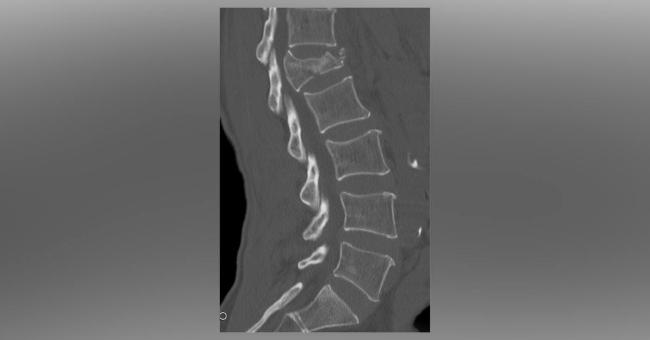 Interpret The Diagnosis From This Sagittal Ct Of Lumbar Spine