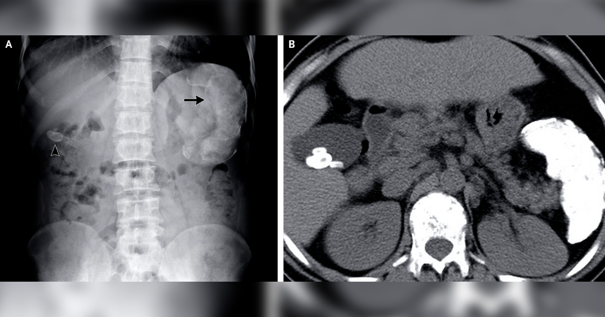 Identify This Condition In A HCV Infected Male