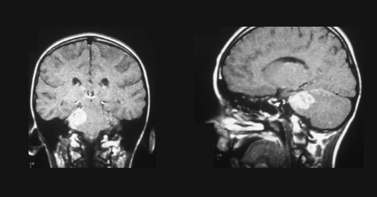What Does This MRI Reveal?