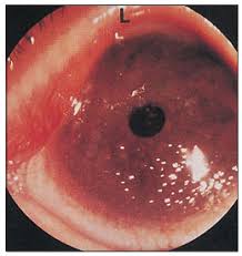 Brief Review On Ocular Manifestations Of Amyloidosis