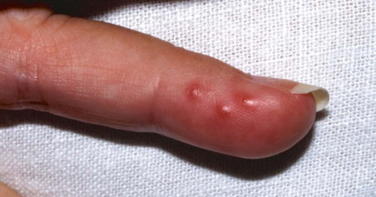 Identify The Infection
