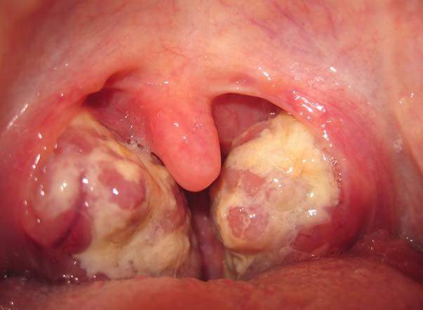 Diagnose The Throat Pain