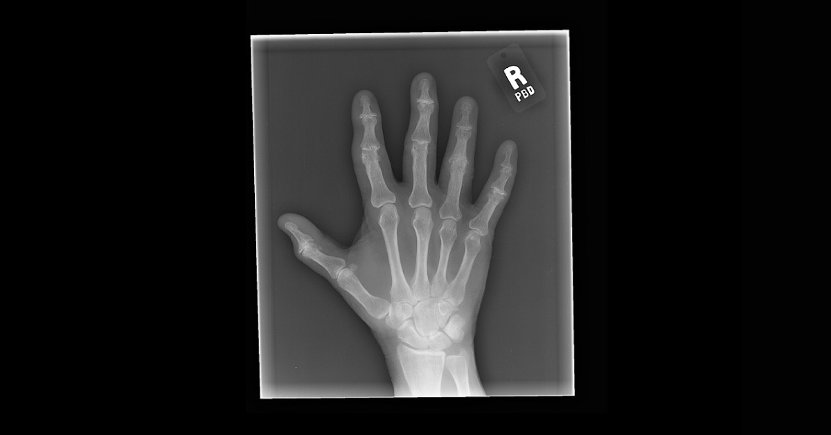 Painful Ring Finger: How can This Case be Managed?