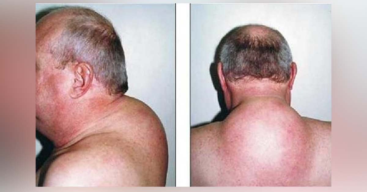 What Is This Neck Bump?