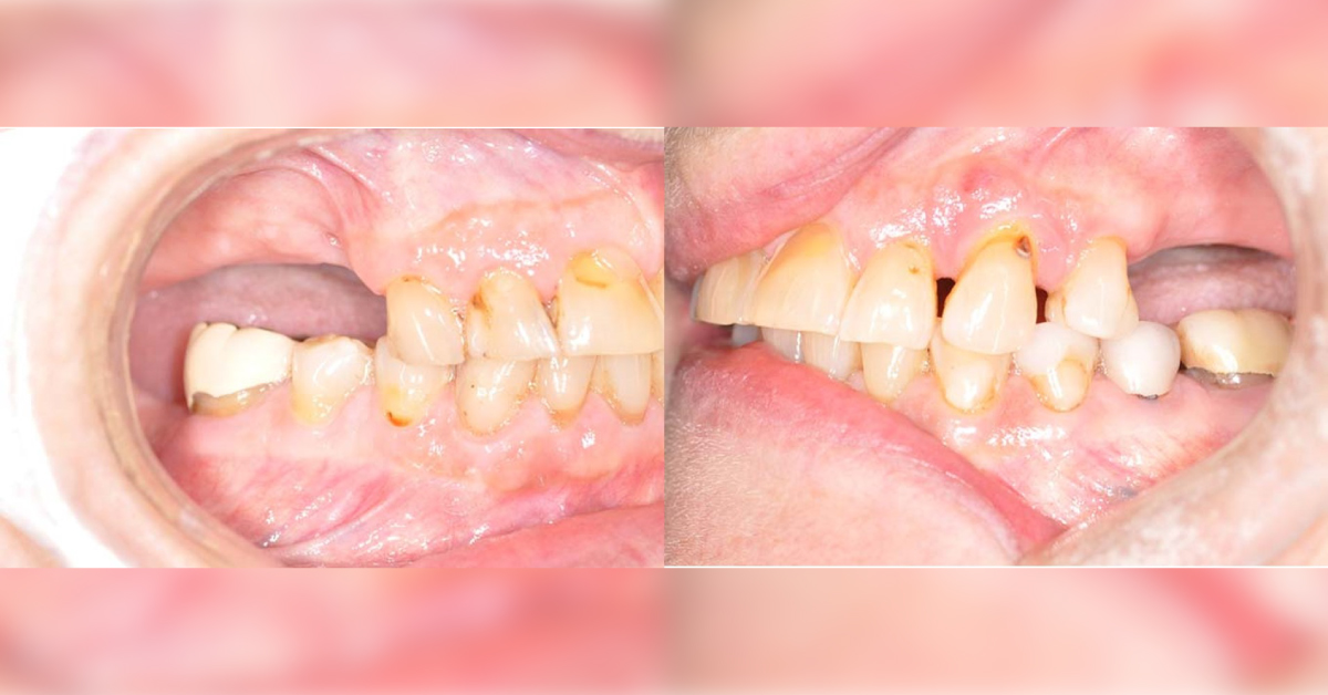 A Case of Partial Upper Dentition