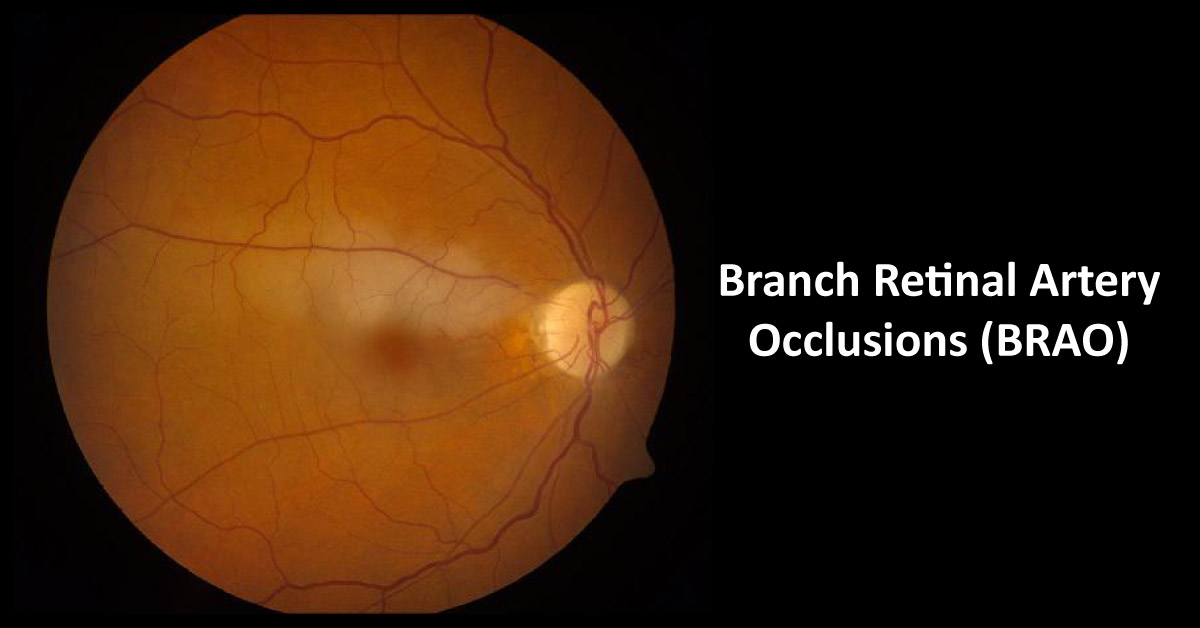 Branch Retinal Artery Occlusions: A Case of A 18-year-old woman