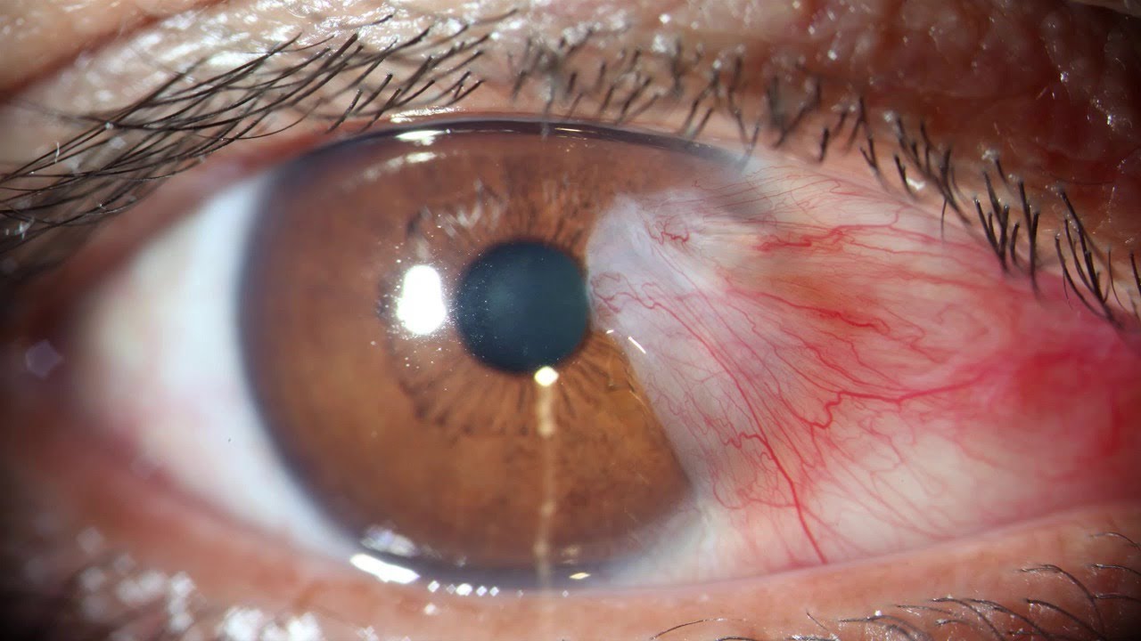 Surgical Modalities Of Pterygium