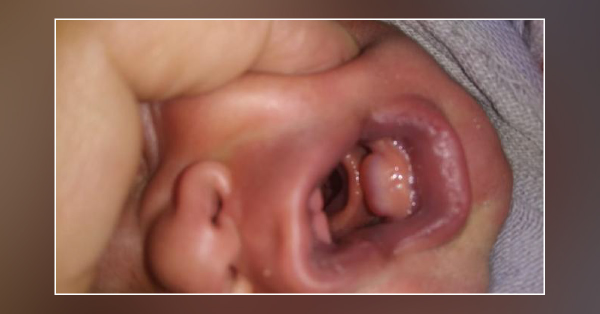 Case Of Swelling Over Lower Jaw