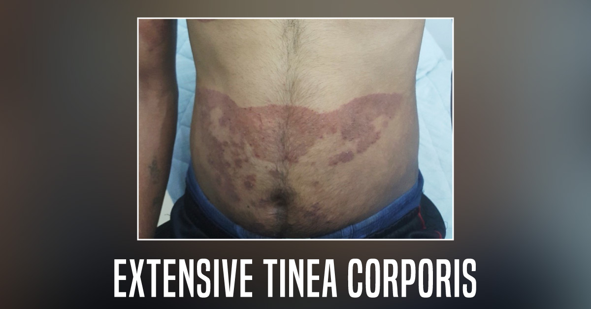 Tinea Infections (Dermatophytosis): Time To Learn More