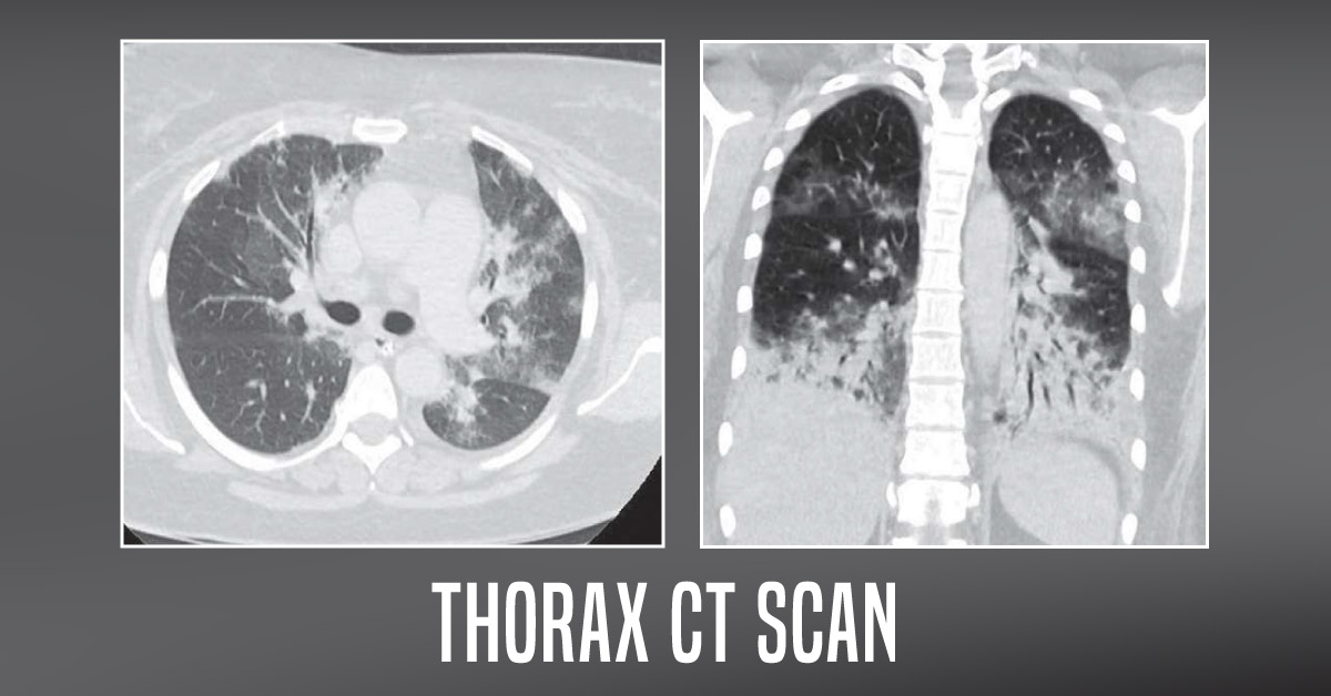 Case of an Ex-smoker with Cough and Fever