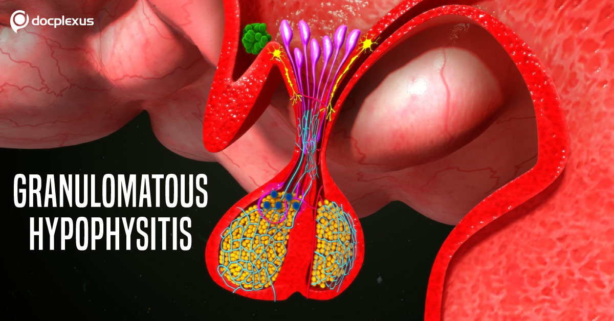Granulomatous Hypophysitis: A Disease With Challenging Diagnosis