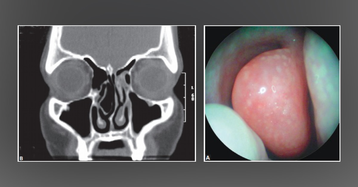 A Case of Recurrent Acute Sinusitis