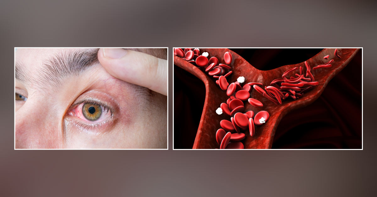 Ocular Manifestations Of Anaemia