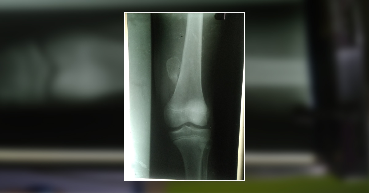 Case Of Swelling Over Left Mid Thigh