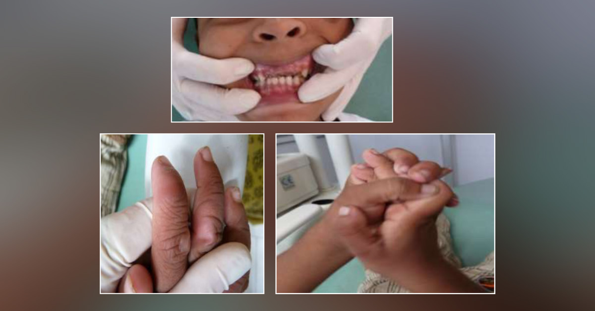 Case of a Young Girl with Decayed Upper Teeth