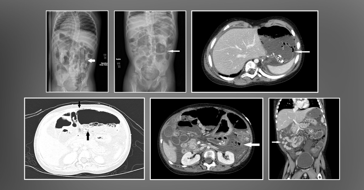 Diagnose This Child with Abdominal Distention
