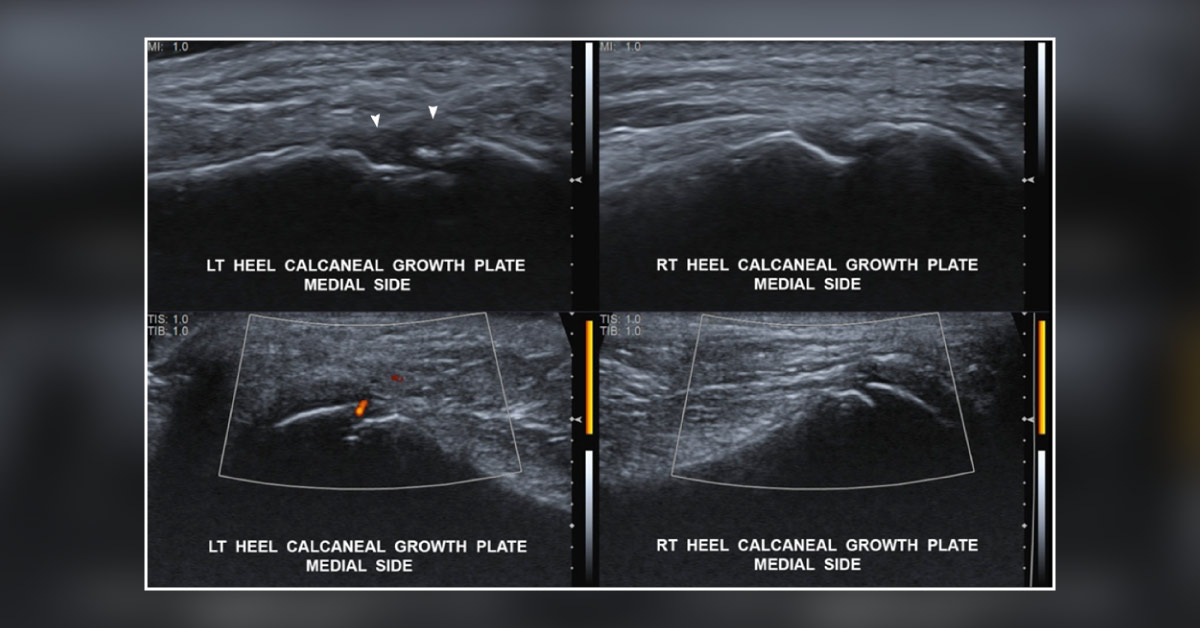 Case of an Athlete with Severe Localized Heel Pain