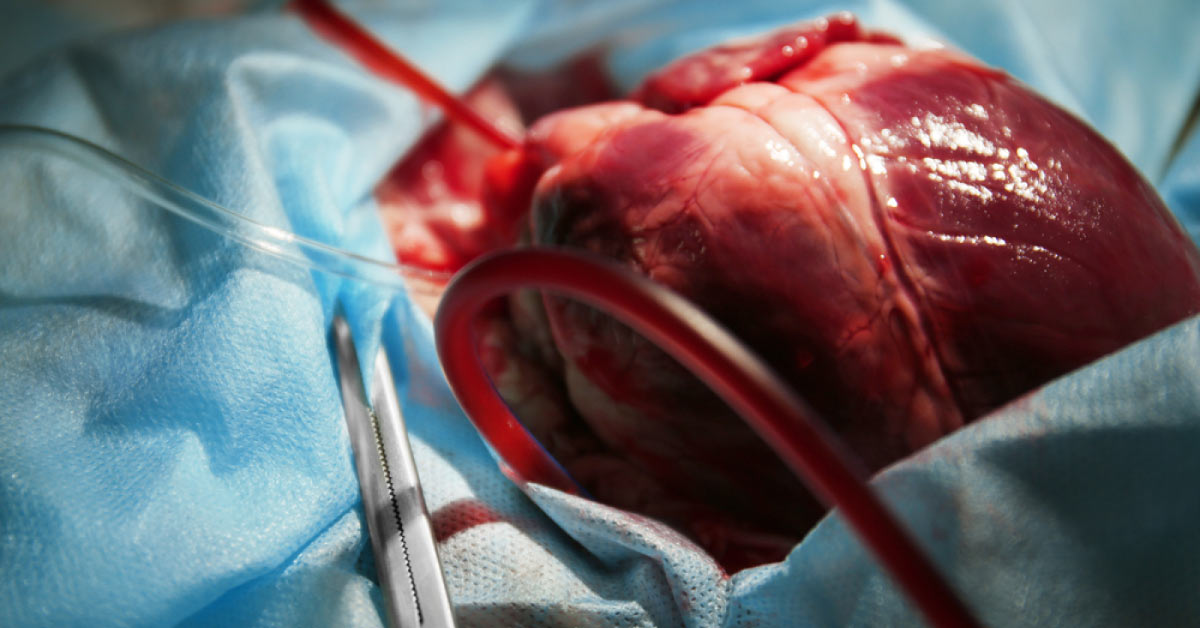 Barriers in a Successful Heart Transplant